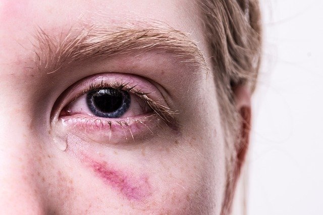 trauma-3485235_640 why do my tears burn my face