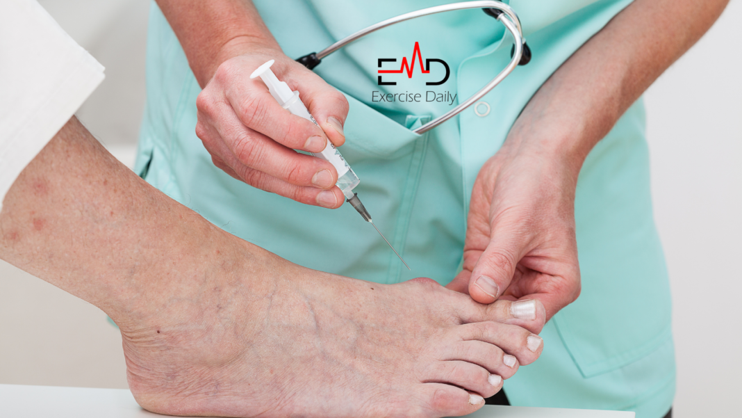 how to shrink bunions naturally