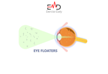 Are Floaters in the Eye Dangerous? are floaters in the eye dangerous