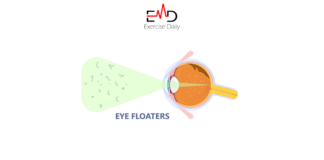 are floaters in the eye dangerous