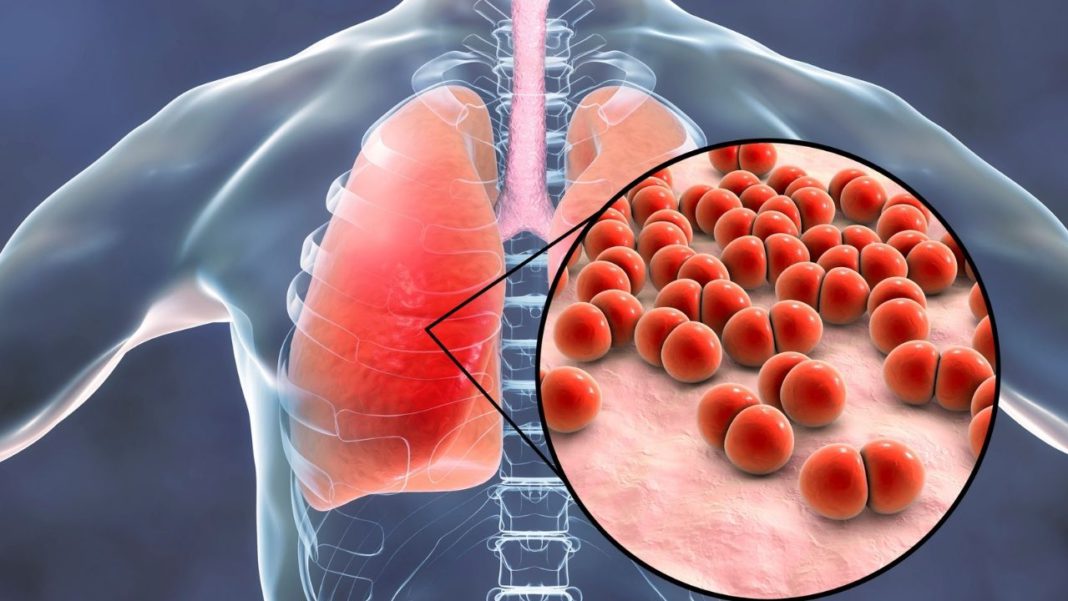 Can Bronchitis Turn into Pneumonia?