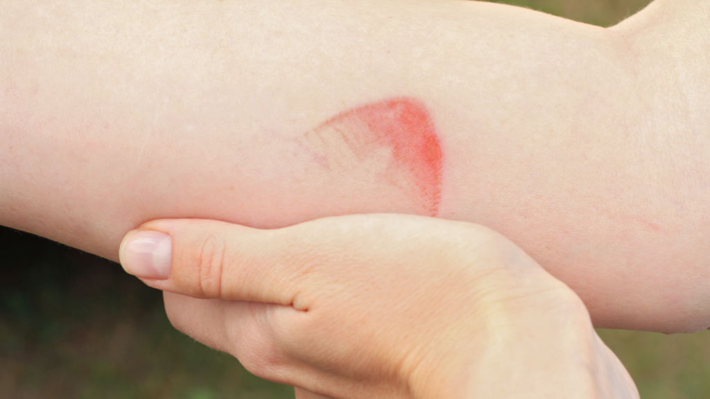 how to treat a burn from a hot pan