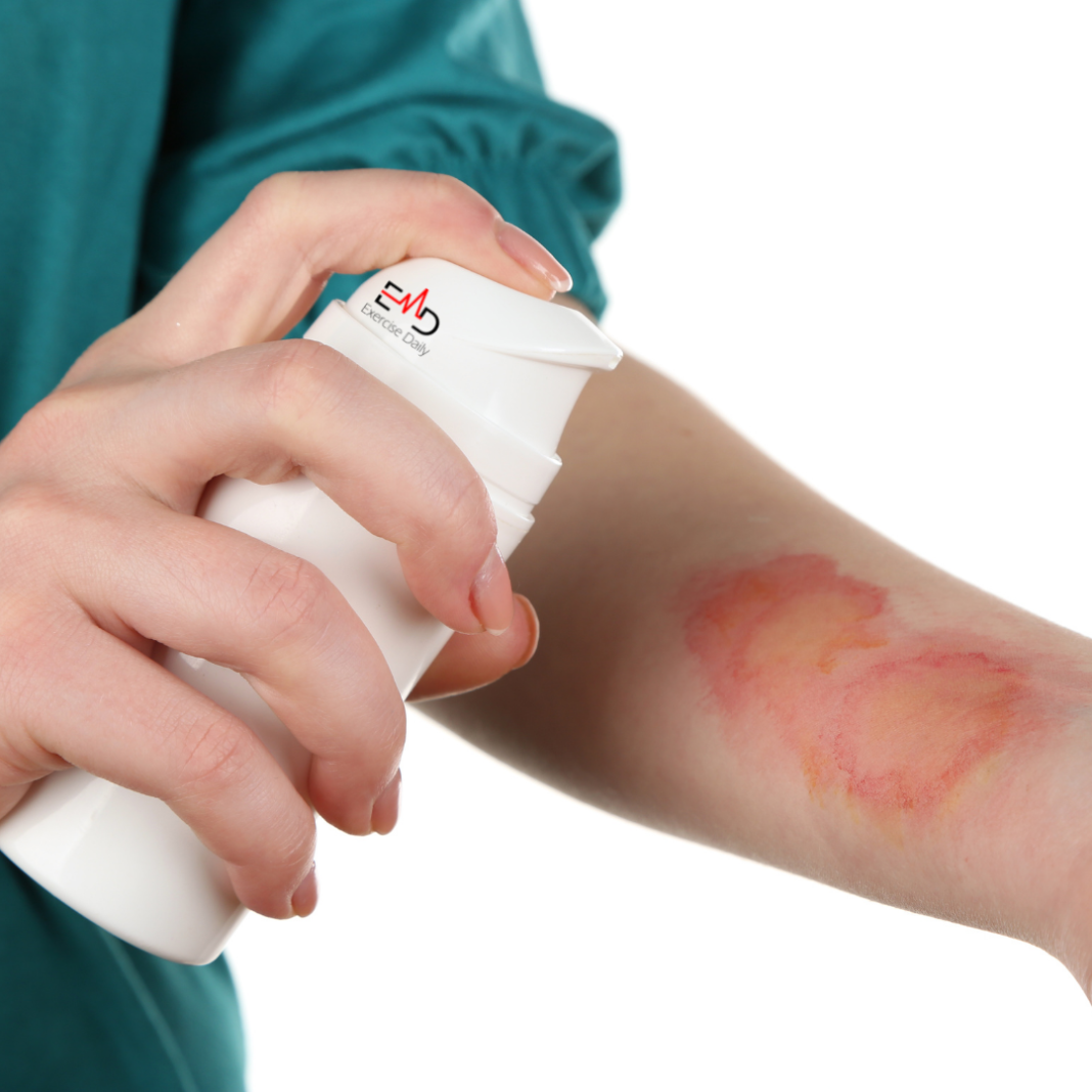 How to Treat a Burn From a Hot Pan?