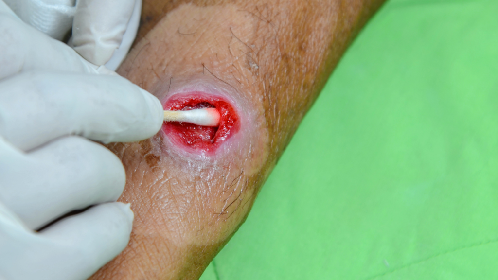 can cellulitis kill you?