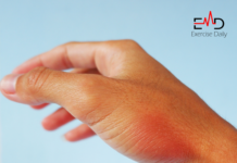 Can Cellulitis Kill You? can cellulitis kill you