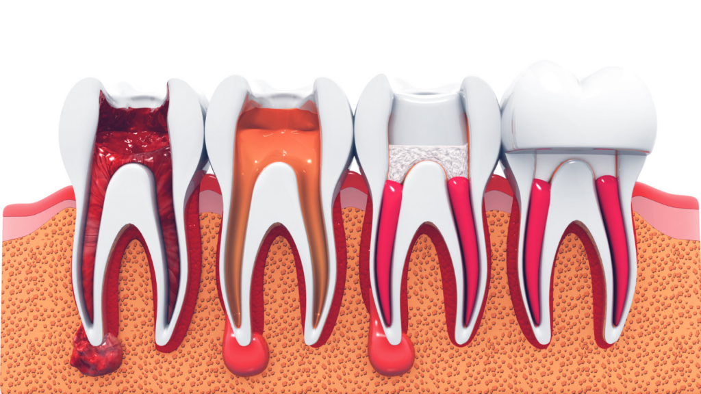 pain after root canal how long