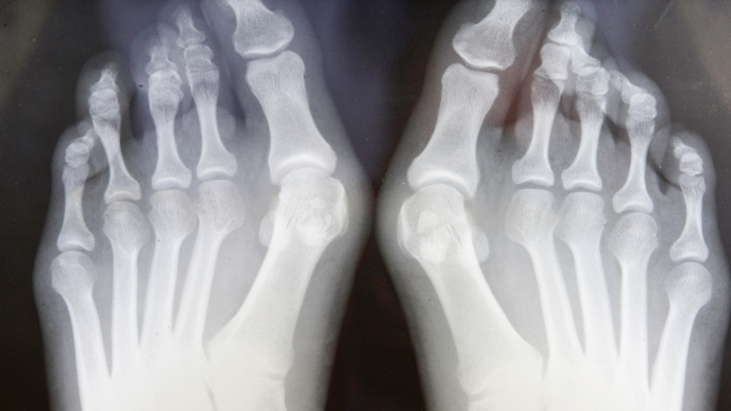 are bunions genetic