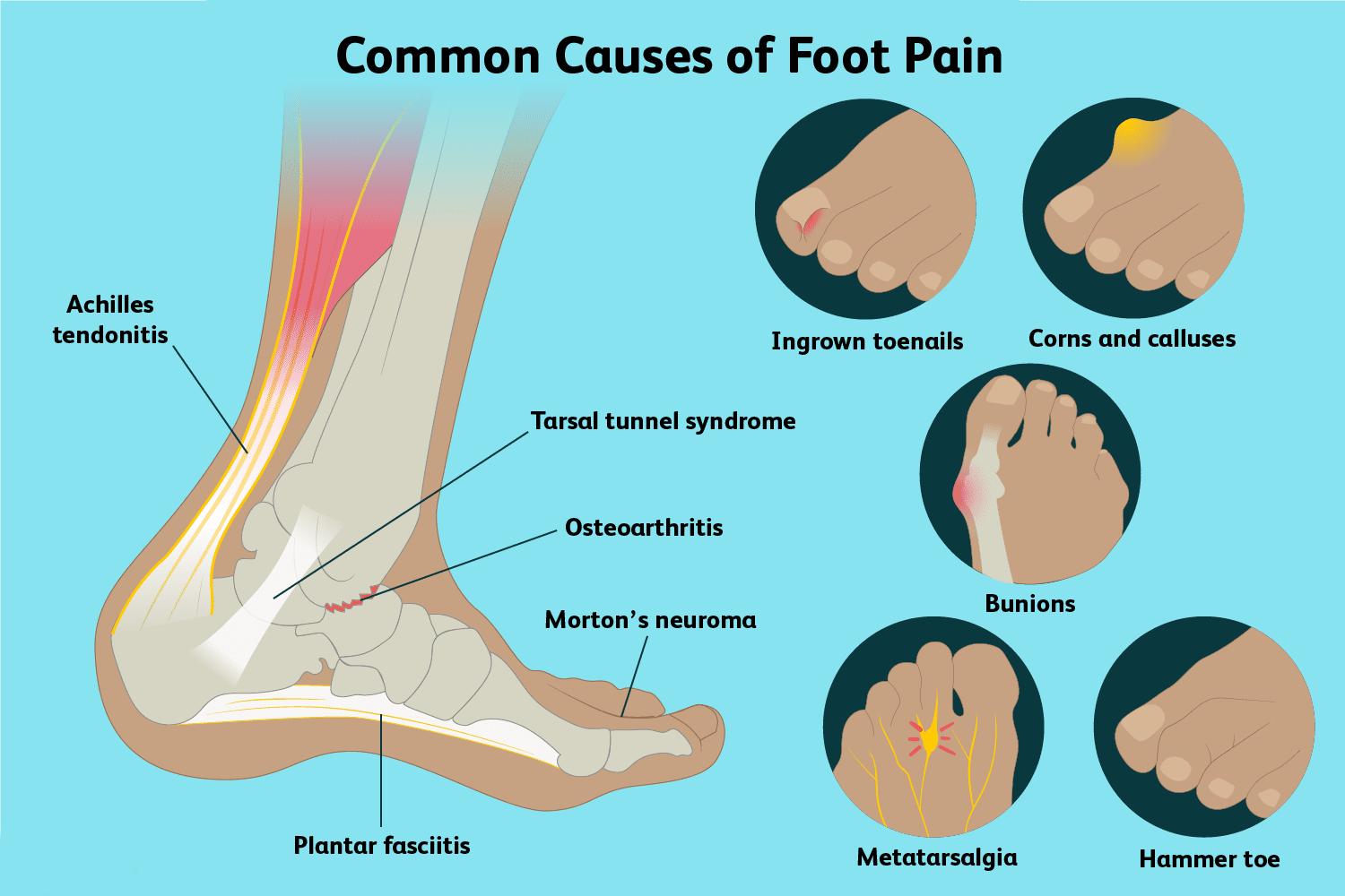 Foot Anatomy: The Five Muscles of the Foot