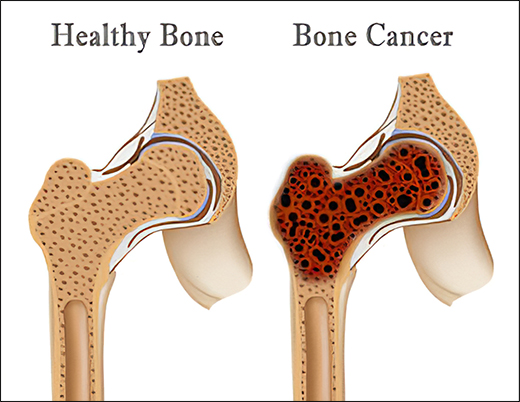 Home Remedies for Bone Cancer