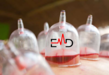 Wet Cupping Benefits A Natural Remedy for Pain and Inflammation