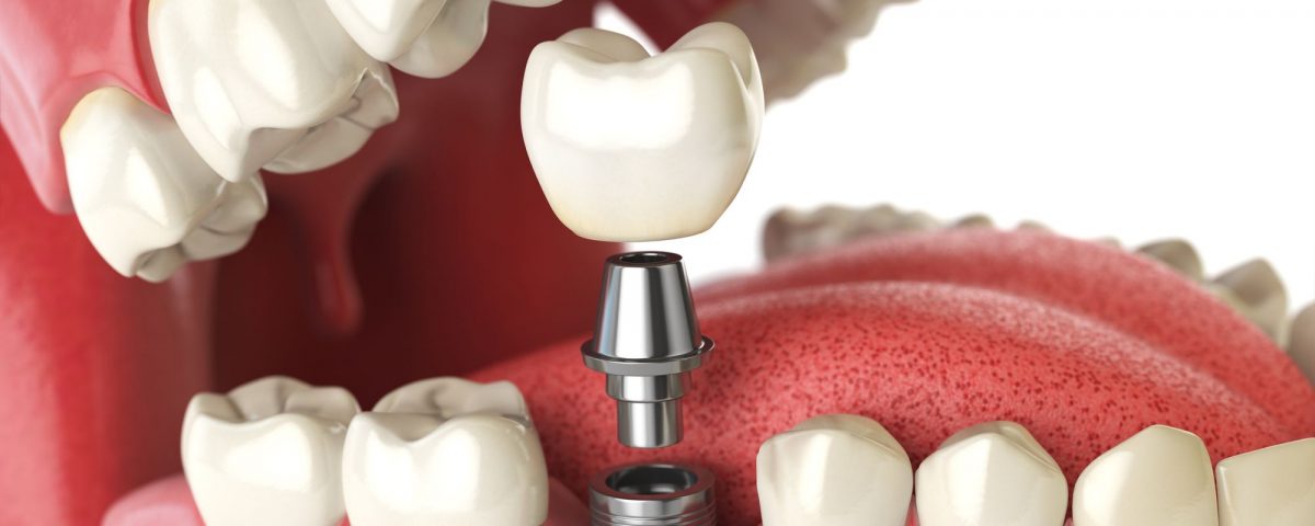 The Cost-Effectiveness of Dental Implants in Mexico