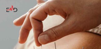Acupuncture: Benefits, Risks, and How it Works