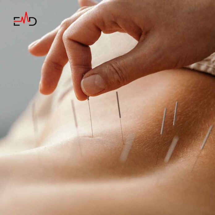 Acupuncture